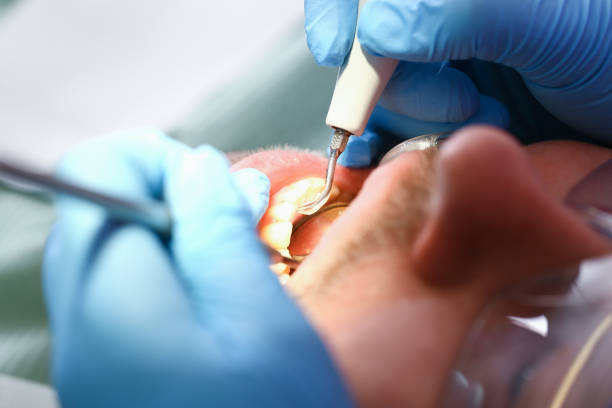 Best Emergency Dental Extractions in Woburn, MA